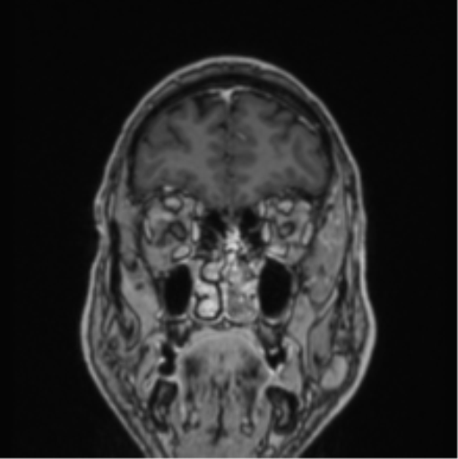 File:Colloid cyst of the third ventricle (Radiopaedia 86571-102662 Coronal T1 C+ 76).png