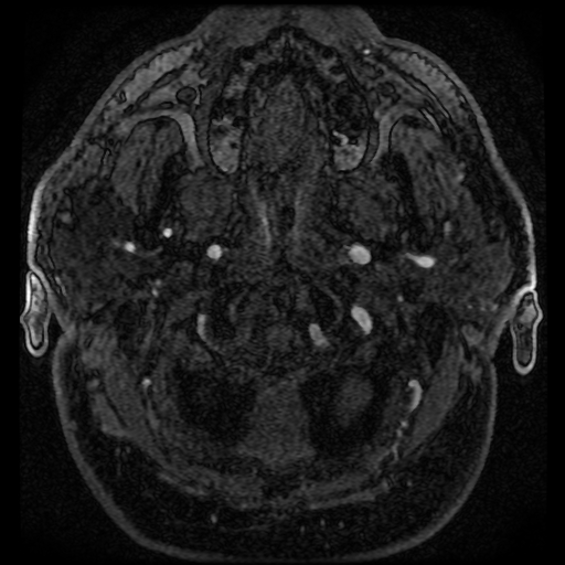 File:Colloid cyst with anterior communicating artery aneurysm (Radiopaedia 33901-35091 Axial MRA 22).jpg
