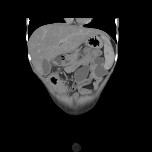 File:Colocolic fistula - Crohn disease (Radiopaedia 57063-63955 B 9).jpg