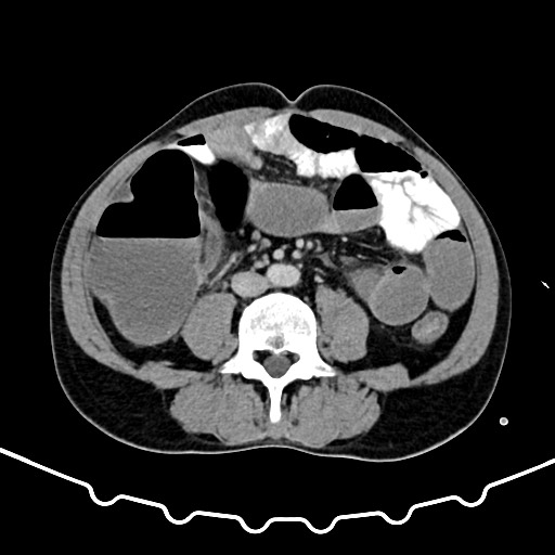 Colocolic intussusception due to large lipoma (Radiopaedia 68773-78482 A 110).jpg