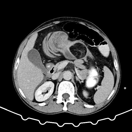 File:Colocolic intussusception due to large lipoma (Radiopaedia 68773-78482 Axial 1).jpg