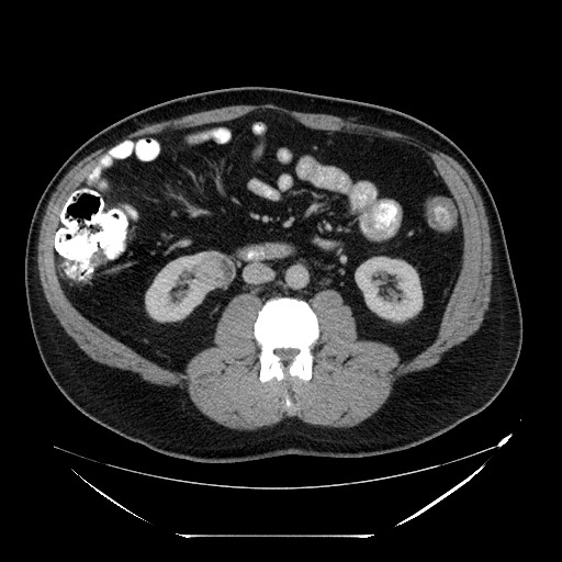 Colocolic intussusception due to lipoma (Radiopaedia 73712-84508 A 58).jpg
