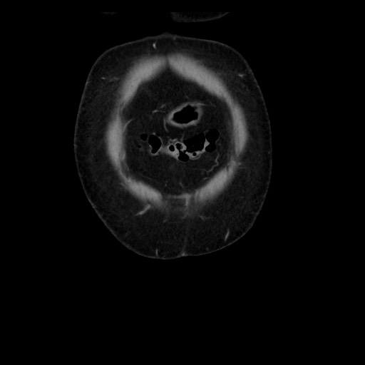 Colocolic intussusception due to tubular adenoma (Radiopaedia 73744-84551 B 18).jpg