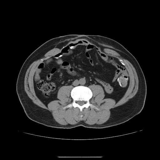 File:Colocutaneous fistula in Crohn's disease (Radiopaedia 29586-30093 D 8).jpg