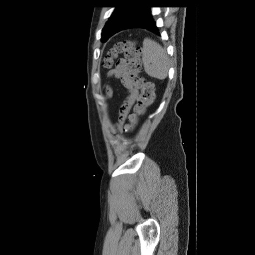 Colocutaneous fistula in Crohn's disease (Radiopaedia 29586-30093 F 52).jpg
