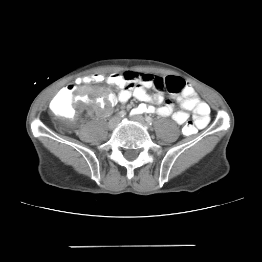 File:Colon cancer with calcified liver metastasis (Radiopaedia 74423-85307 A 50).jpg