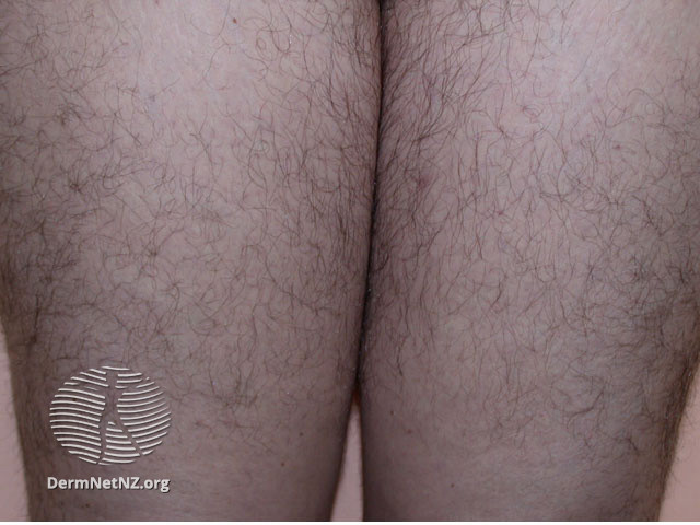 File:DermNet NZ hair-nails-sweat-hirsutism1.jpg
