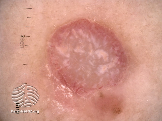 File:Dermoscopic image of amelanotic melanoma 1 (DermNet NZ amelanotic-melanoma-dermoscopy).jpg