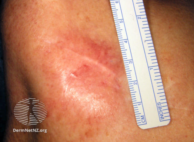 File:Desmoplastic melanoma (DermNet NZ Desmoplastic-melanoma-1-v2).jpg