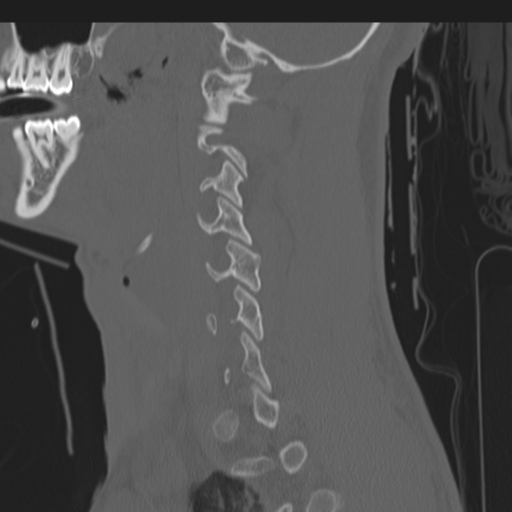 File:Multitrauma with diffuse axonal injury, temporal bone fractures and traumatic caroticocavernous fistula (Radiopaedia 37242-39035 Sagittal 30).png