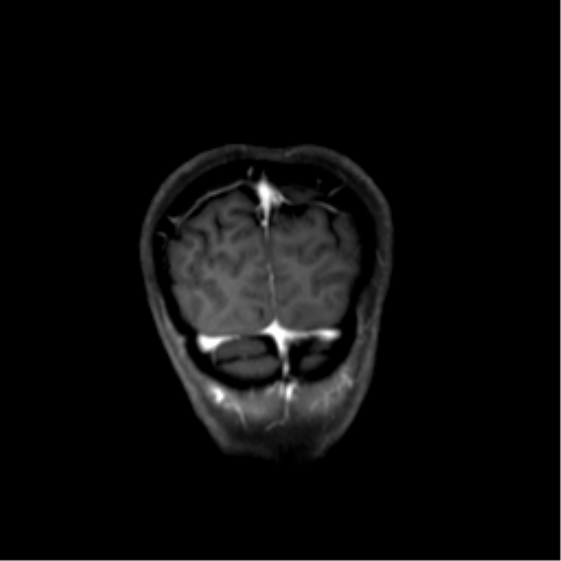File:Nasopharyngeal carcinoma with cerebral abscess (Radiopaedia 43018-46274 L 50).png