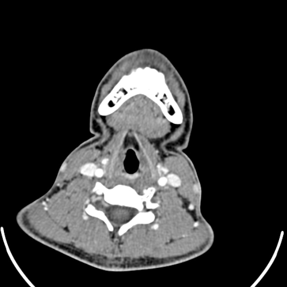 Nasopharyngeal carcinoma with skull base invasion (Radiopaedia 53415-59705 A 145).jpg