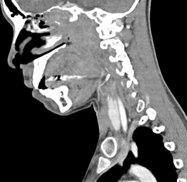 Nasopharyngeal carcinoma with skull base invasion (Radiopaedia 53415-59705 C 43).jpg