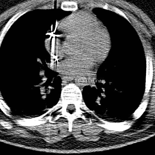 File:Neck CT angiogram (intraosseous vascular access) (Radiopaedia 55481-61945 Axial Monitoring 4).jpg