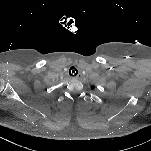 File:Neck CT angiogram (intraosseous vascular access) (Radiopaedia 55481-61945 B 107).jpg