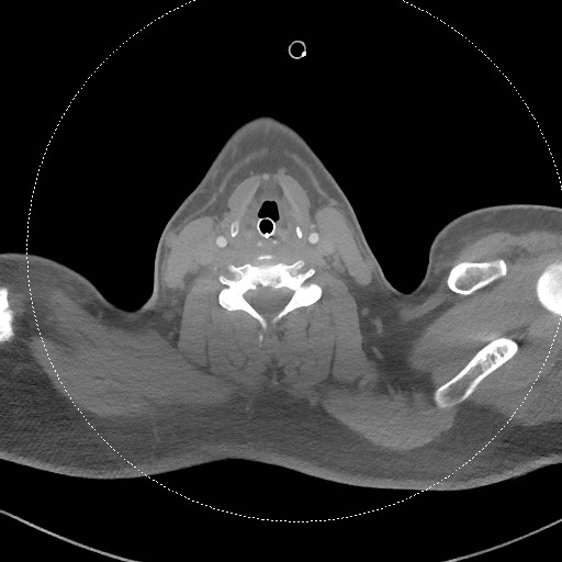 Neck CT angiogram (intraosseous vascular access) (Radiopaedia 55481-61945 B 163).jpg