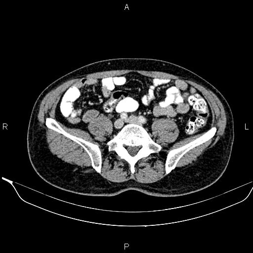 Necrotizing pancreatitis (Radiopaedia 87796-104249 A 39).jpg