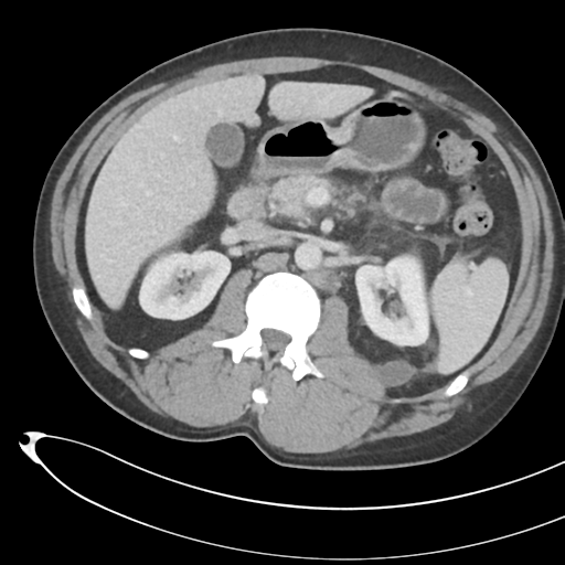 File:Necrotizing pancreatitis with acute necrotic collections (Radiopaedia 38829-41012 B 32).png