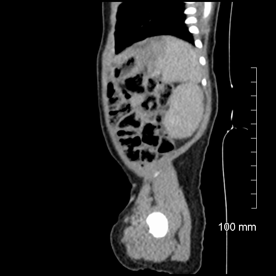 File:Neonatal neuroblastoma (Radiopaedia 56651-63438 C 23).jpg