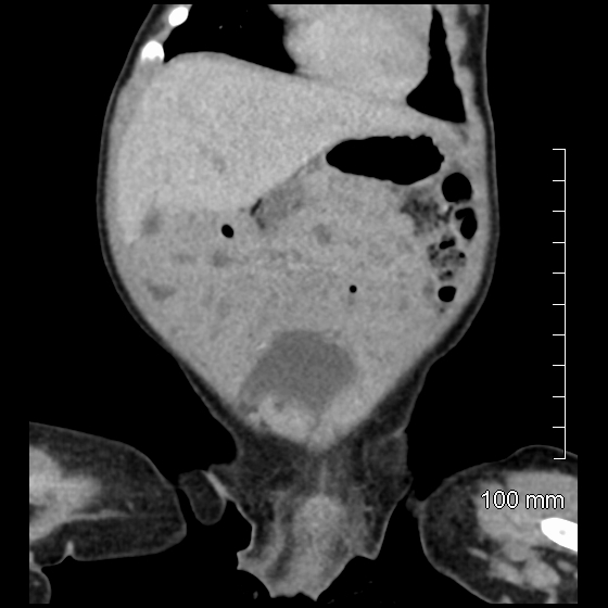 File:Neonatal neuroblastoma (Radiopaedia 56651-63438 Coronal non-contrast 14).jpg
