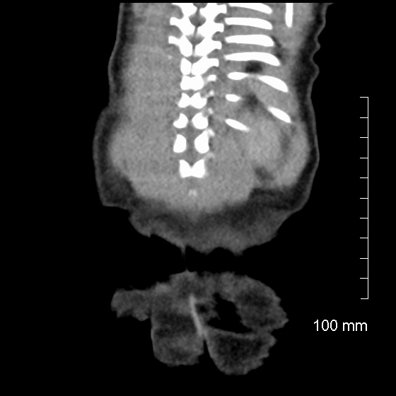 File:Neonatal neuroblastoma (Radiopaedia 56651-63438 Coronal non-contrast 45).jpg