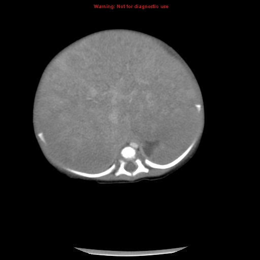 File:Neonatal neuroblastoma (Radiopaedia 9564-10223 A 18).jpg