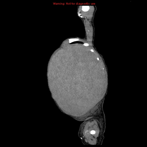 File:Neonatal neuroblastoma (Radiopaedia 9564-10223 C 21).jpg