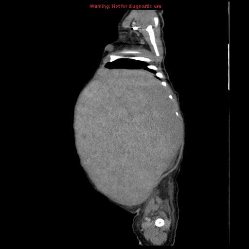 File:Neonatal neuroblastoma (Radiopaedia 9564-10223 C 29).jpg