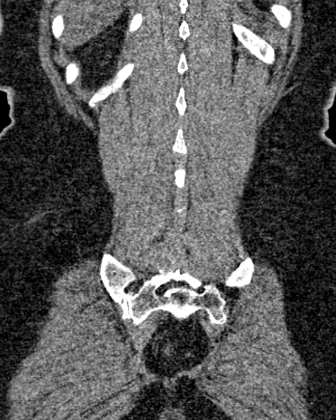 File:Nephrostomy for urosepsis (Radiopaedia 26180-26330 non-contrast 76).jpg