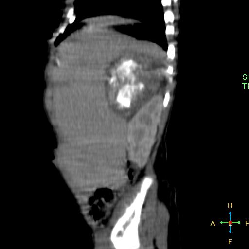 File:Neuroblastoma (Radiopaedia 24751-25016 C 25).jpg