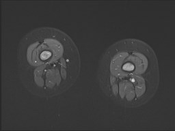 File:Neuroblastoma with bone metastases (Radiopaedia 67080-76414 Axial STIR 19).jpg