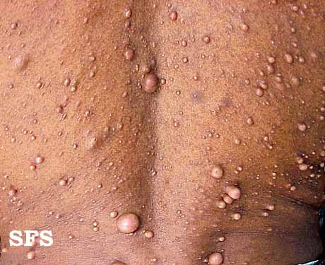 File:Neurofibromatosis (Dermatology Atlas 5).jpg