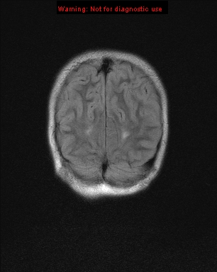 File:Neurofibromatosis type 1 with optic nerve glioma (Radiopaedia 16288-15965 Coronal FLAIR 3).jpg