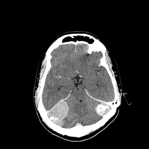 File:Neurofibromatosis type 2 (Radiopaedia 25389-25637 Axial C+ 28).jpg