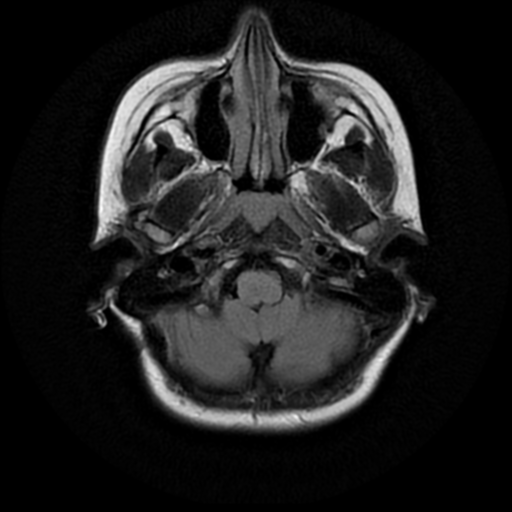 File:Neurofibromatosis type 2 (Radiopaedia 45229-49244 Axial FLAIR 2).png