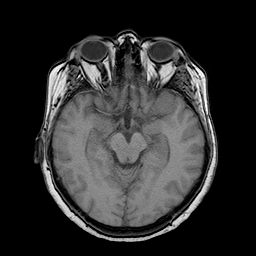 File:Neurofibromatosis type 2 (Radiopaedia 8713-9518 Axial T1 15).jpg