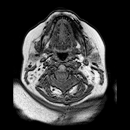 File:Neurofibromatosis type 2 (Radiopaedia 8713-9518 Axial T1 28).jpg