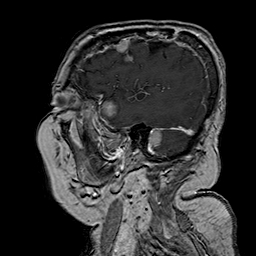 File:Neurofibromatosis type 2 (Radiopaedia 8713-9518 Sagittal T1 C+ 11).jpg