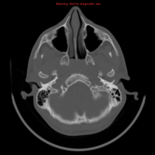 File:Neurofibromatosis type 2 (Radiopaedia 8953-9732 Axial bone window 3).jpg