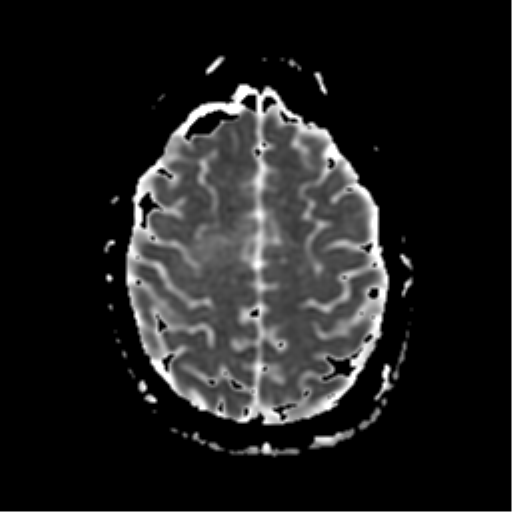File:Neurofibromatosis type 2 - bilateral acoustic neuromata (Radiopaedia 40060-42566 Axial ADC 17).png