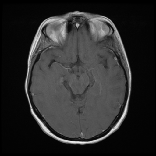 File:Neurofibromatosis type 2 - bilateral acoustic neuromata (Radiopaedia 40060-42566 Axial T1 C+ 9).png