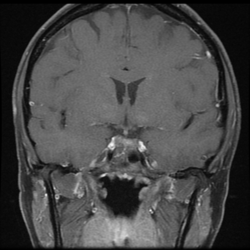 File:Neurofibromatosis type 2 - bilateral acoustic neuromata (Radiopaedia 40060-42566 Coronal T1 C+ 10).png
