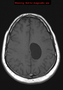 File:Neuroglial cyst (Radiopaedia 10713-11184 Axial T1 7).jpg