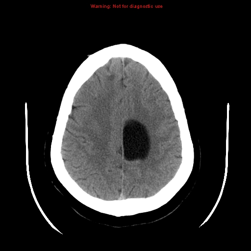 File:Neuroglial cyst (Radiopaedia 10713-11185 Axial non-contrast 9).jpg