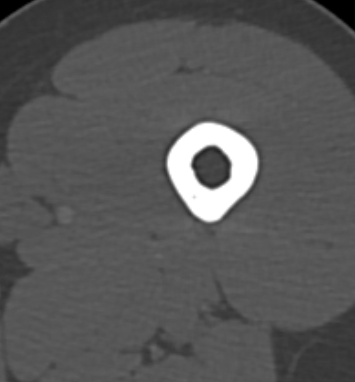 Non-ossifying fibroma - femur (Radiopaedia 82786-97042 Axial bone window 2).jpg