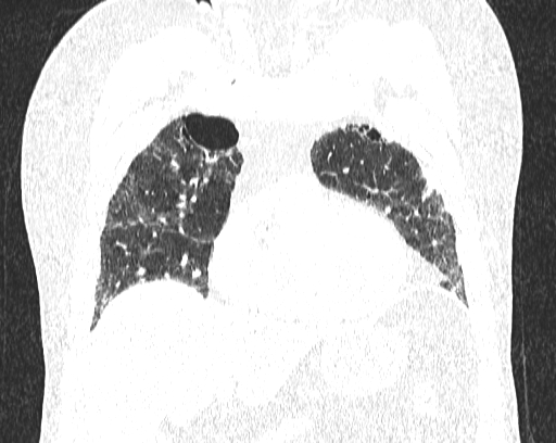 Non-specific interstitial pneumonia (NSIP) (Radiopaedia 68599-78228 Coronal lung window 25).jpg