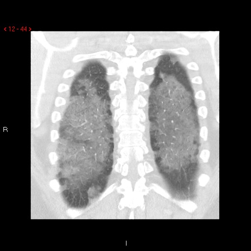 File:Non-specific interstitial pneumonitis (Radiopaedia 27044-27222 Coronal lung window 44).jpg