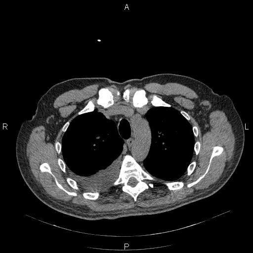 File:Non Hodgkin lymphoma in a patient with ankylosing spondylitis (Radiopaedia 84323-99624 Axial non-contrast 11).jpg
