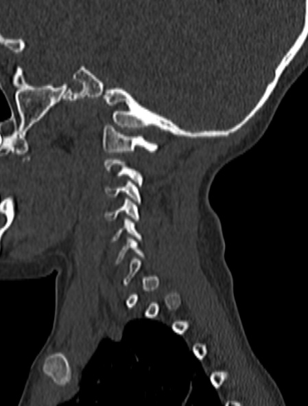 File:Normal CT cervical spine - pediatric (Radiopaedia 52549-58462 Sagittal bone window 180).jpg