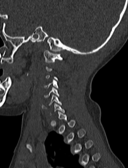 Normal CT cervical spine - pediatric (Radiopaedia 52549-58462 Sagittal bone window 27).jpg